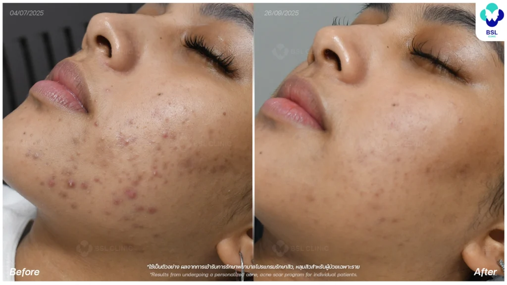 การดูแลผิว รีวิวผลการรักษาสิวอุดตัน