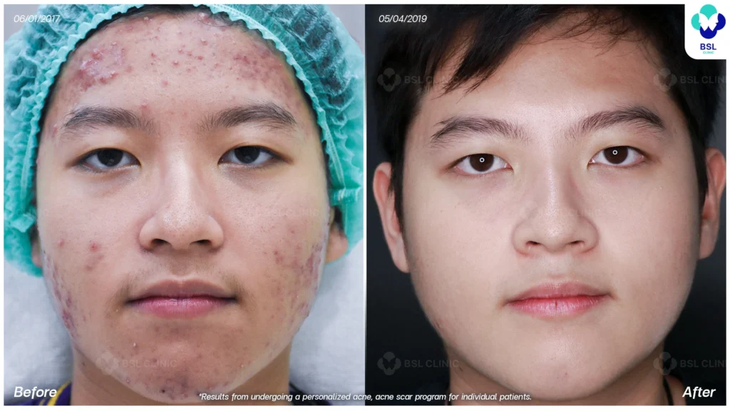 รีวิวรักษาสิวฮอร์โมนผู้ชาย