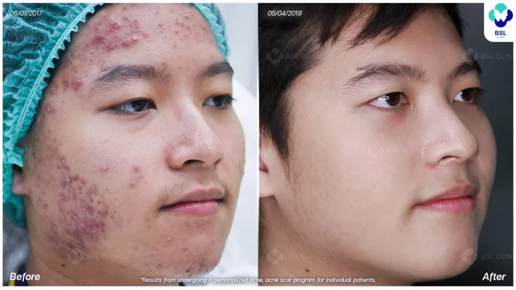 รีวิวรักษาสิวฮอร์โมนผู้ชาย