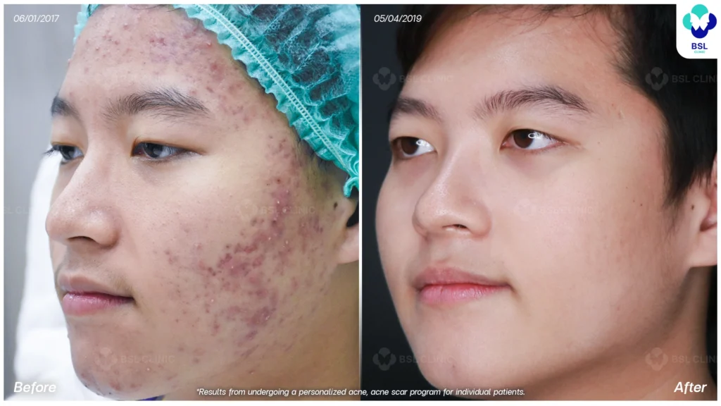 รีวิวรักษาสิวฮอร์โมนผู้ชาย