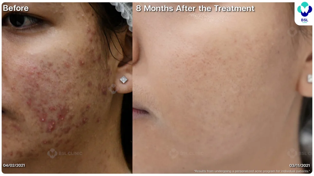 รีวิวรักษาสิว