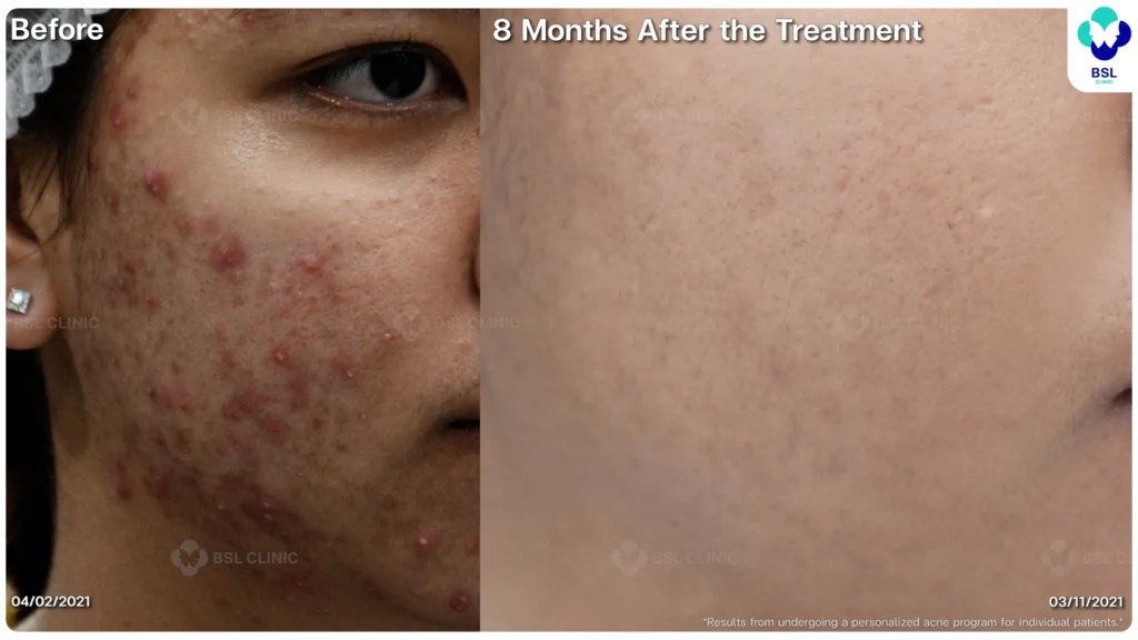 รีวิวรักษาสิว