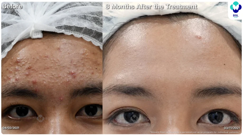 รีวิวรักษาสิว