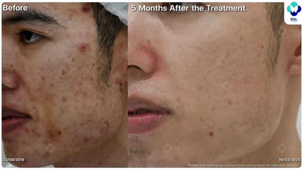 รีวิวรักษาสิว