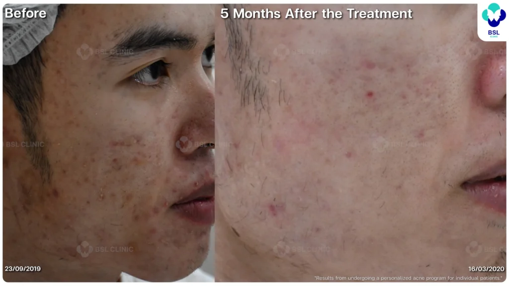 รีวิวรักษาสิว