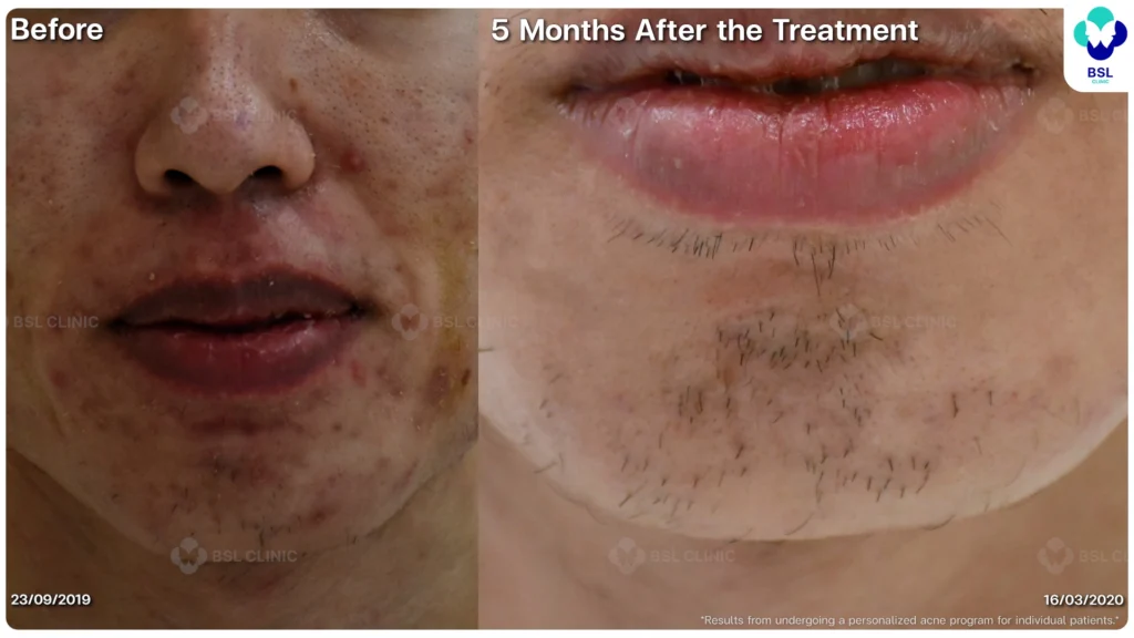 รีวิวรักษาสิว