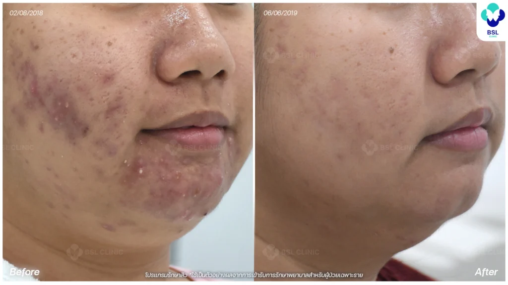 รีวิวรักษาสิว bsl clinic