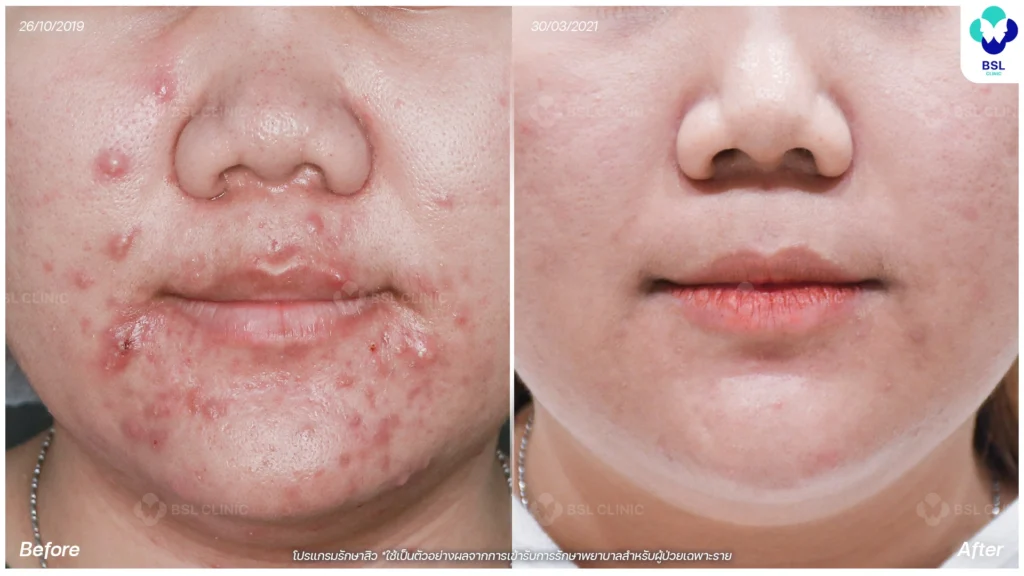 รีวิวรักษาสิว bsl clinic