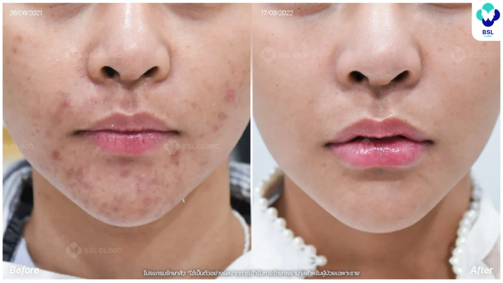 รีวิวรักษาสิว bsl clinic