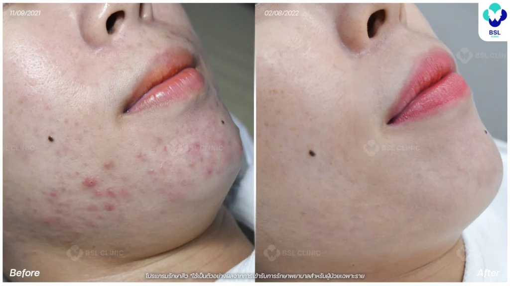 รีวิวรักษาสิว bsl clinic