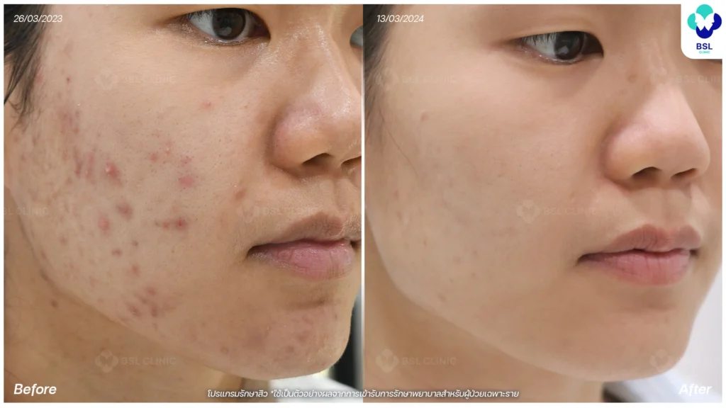 รีวิวรักษาสิว bsl clinic