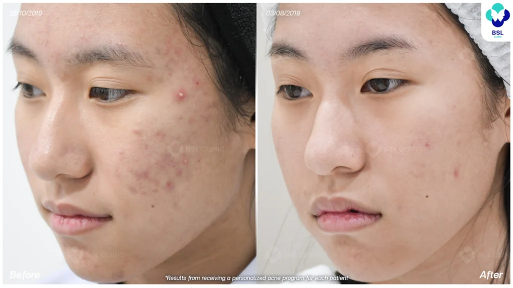 รีวิวรักษาสิวฮอร์โมนผู้หญิง