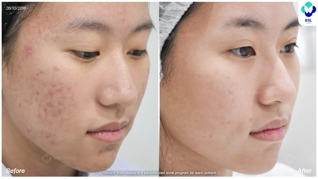 รีวิวรักษาสิวฮอร์โมนผู้หญิง