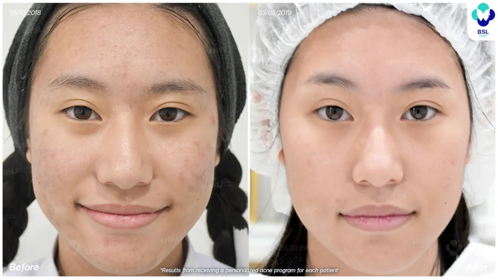 รีวิวรักษาสิวฮอร์โมนผู้หญิง