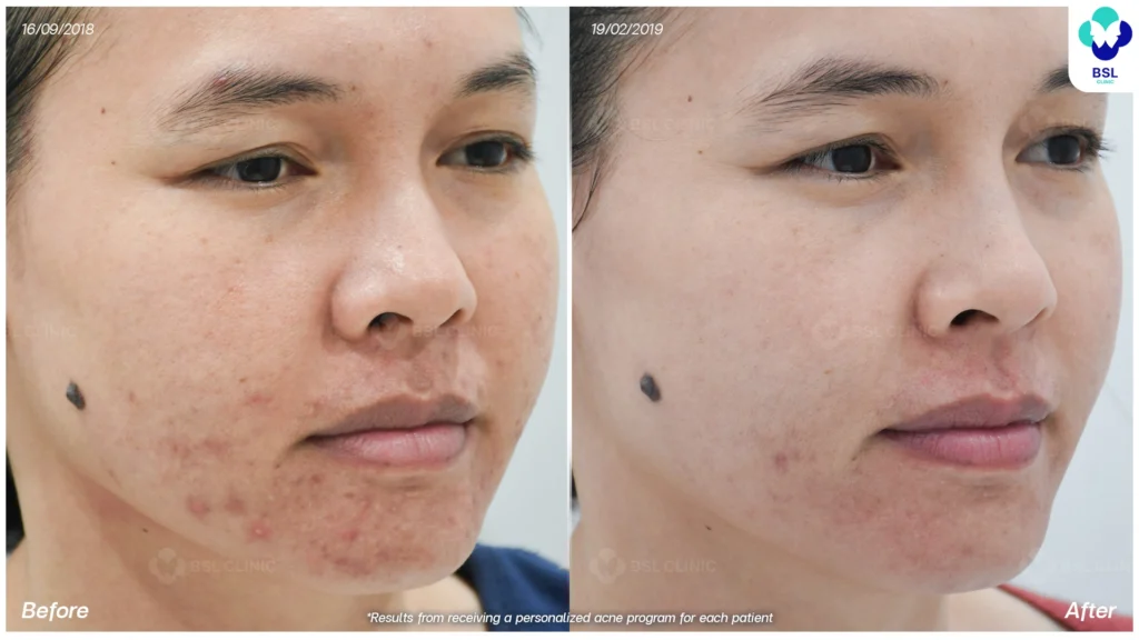 รีวิวรักษาสิว bsl clinic
