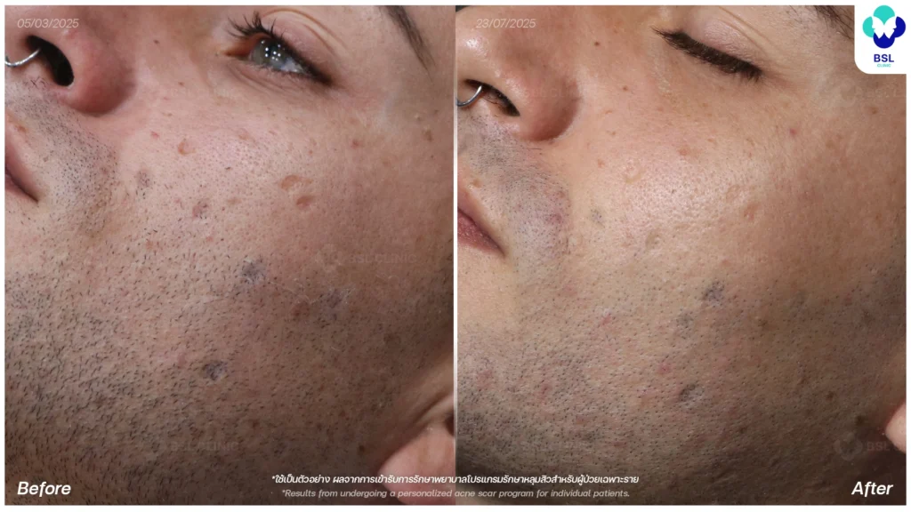 การดูแลผิว รีวิวผลการรักษาหลุมสิว