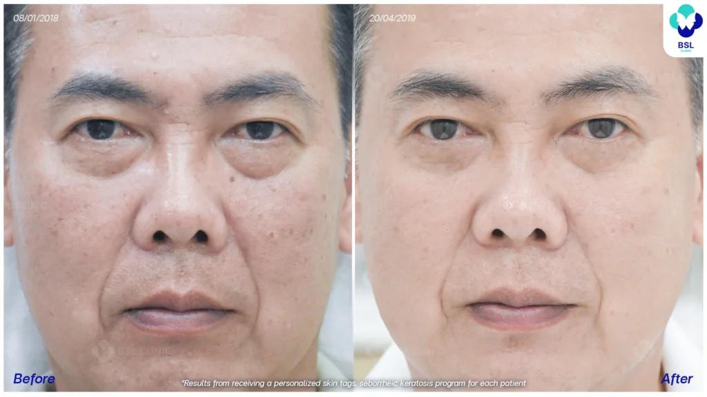 รักษาต่อมไขมัน