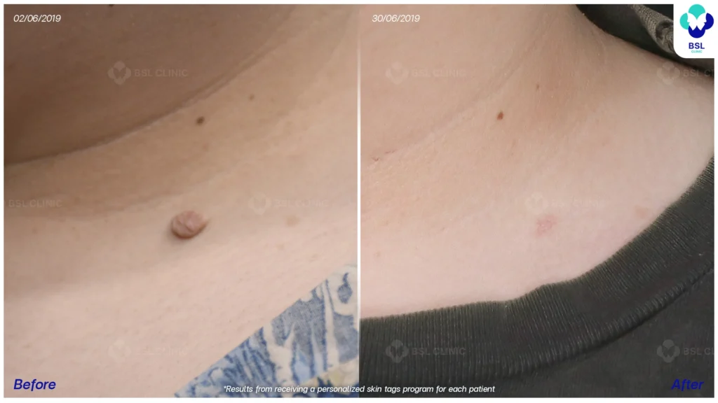 รีวิวกำจัดติ่งเนื้อ