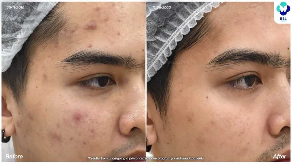 รีวิวรักษาสิว bsl clinic