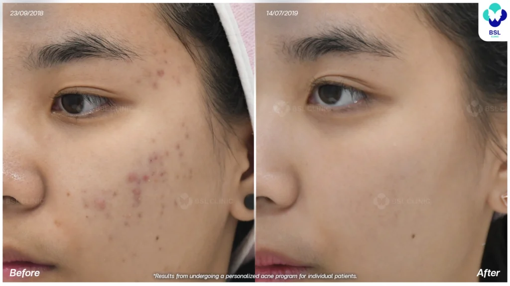 รีวิวรักษาสิว bsl clinic