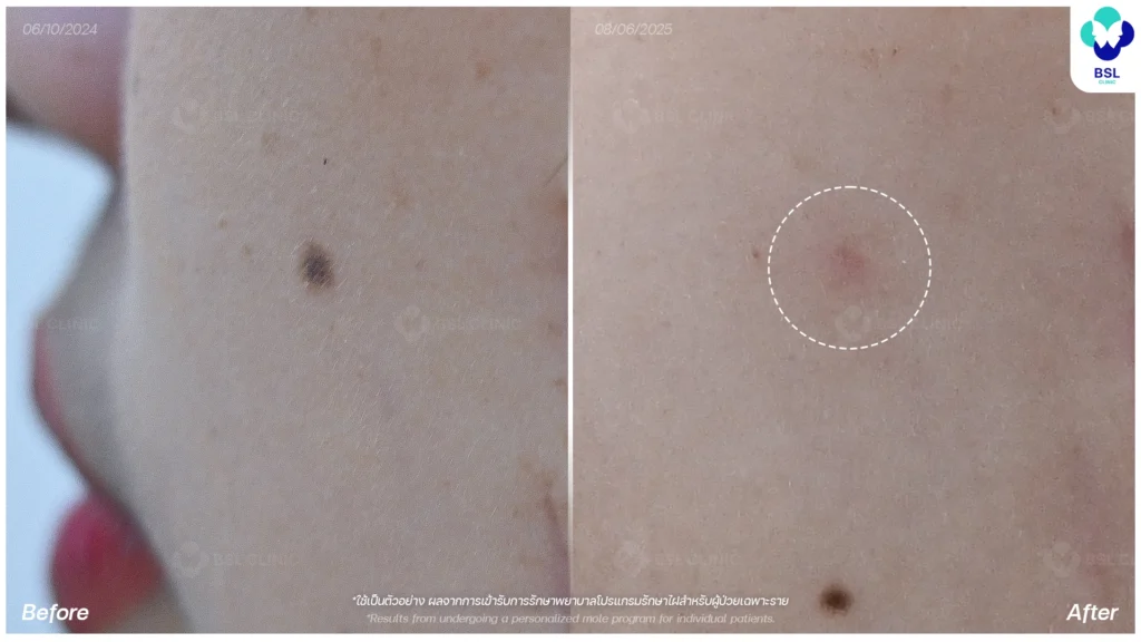 กำจัดไฝ