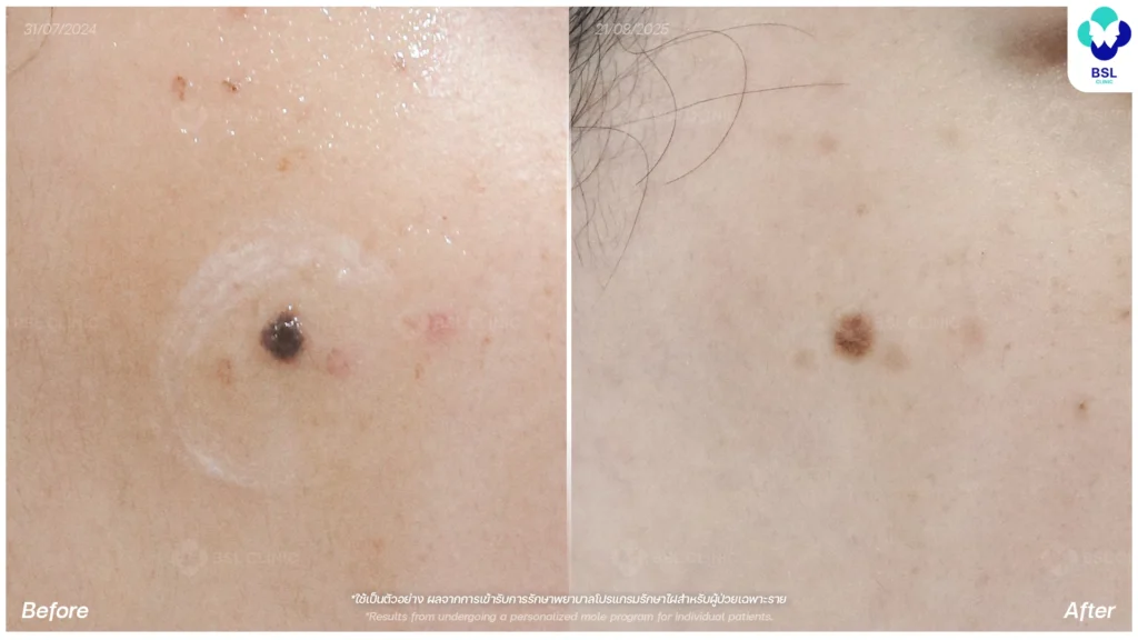 รักษาไฝนูน