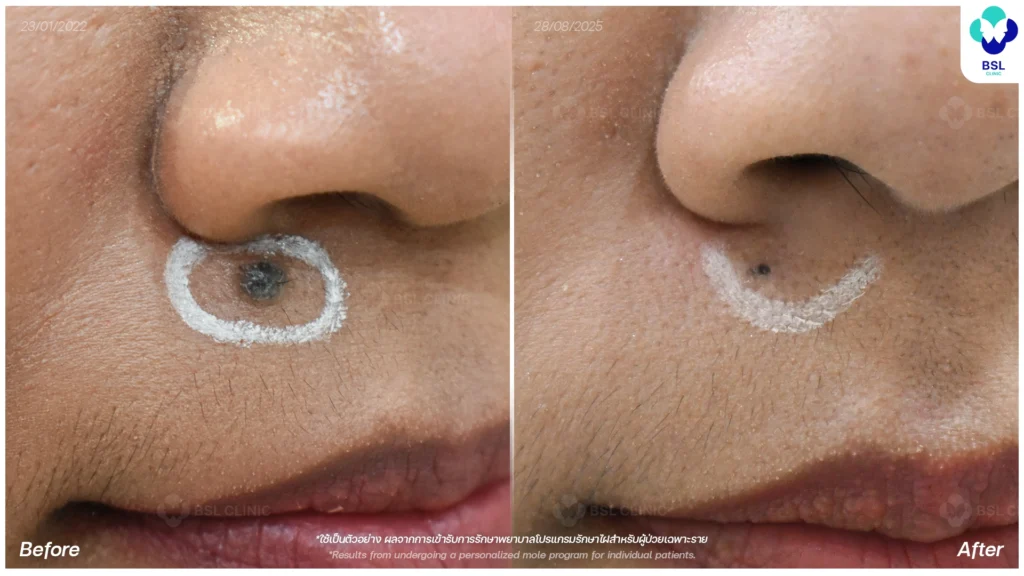 ไฝนูนบริเวณหน้า