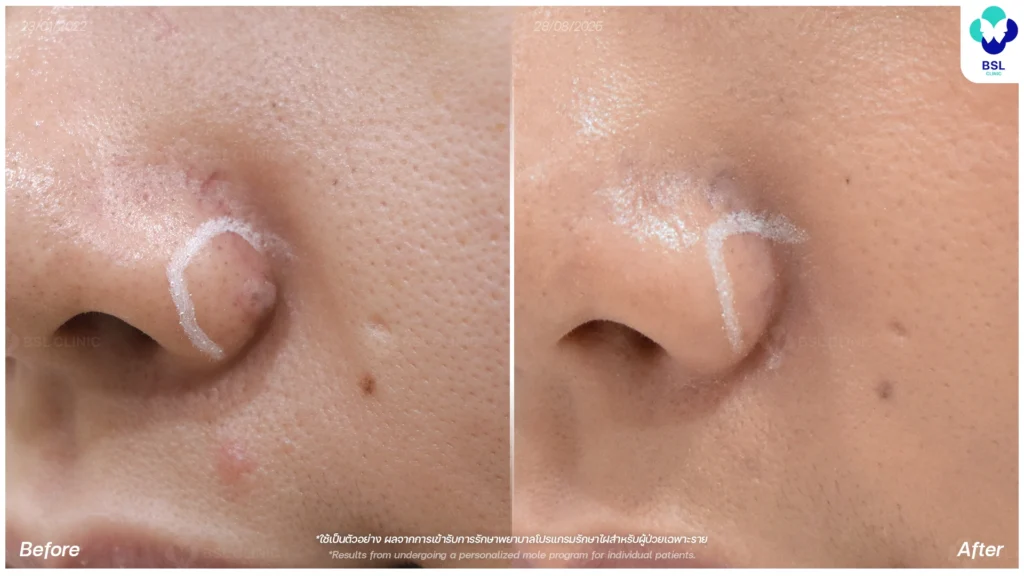 เลเซอร์รักษาไฝนูน