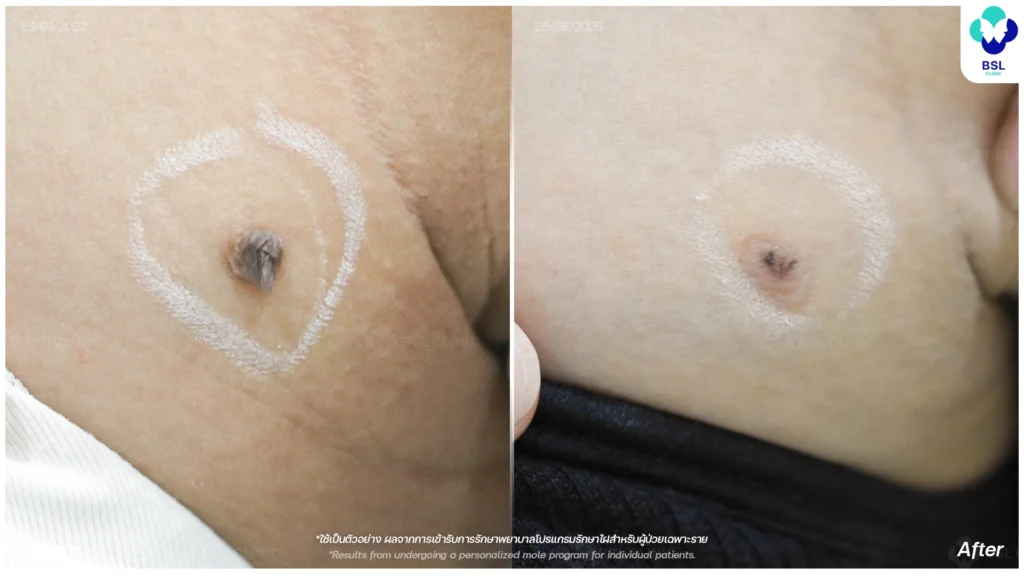 จี้ไฝนูน