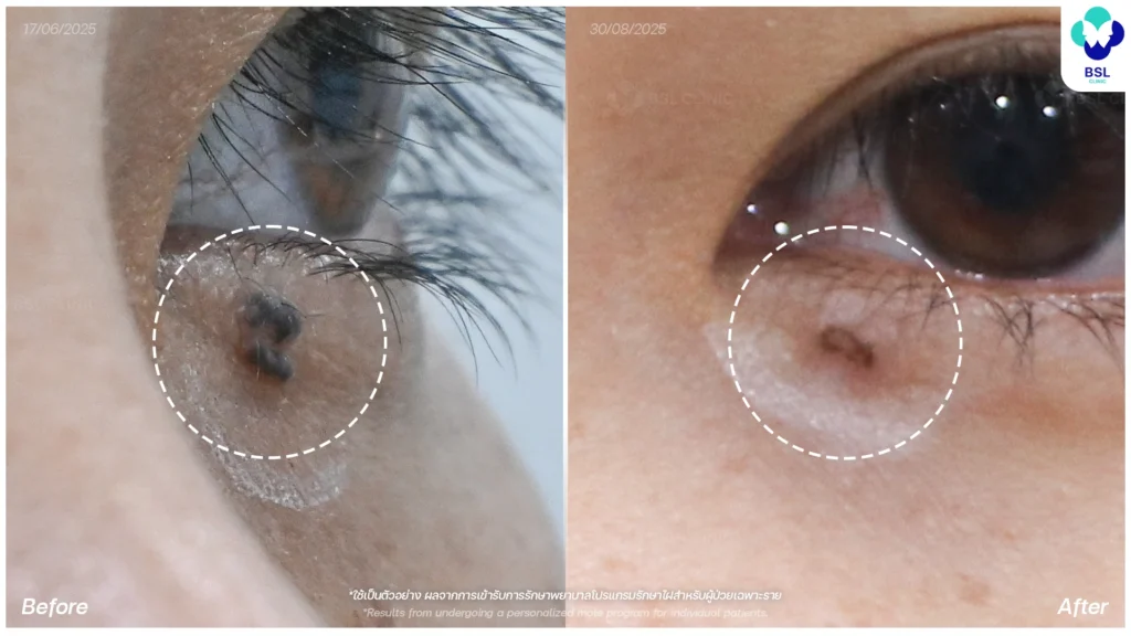 รักษาไฝนูนที่ตา