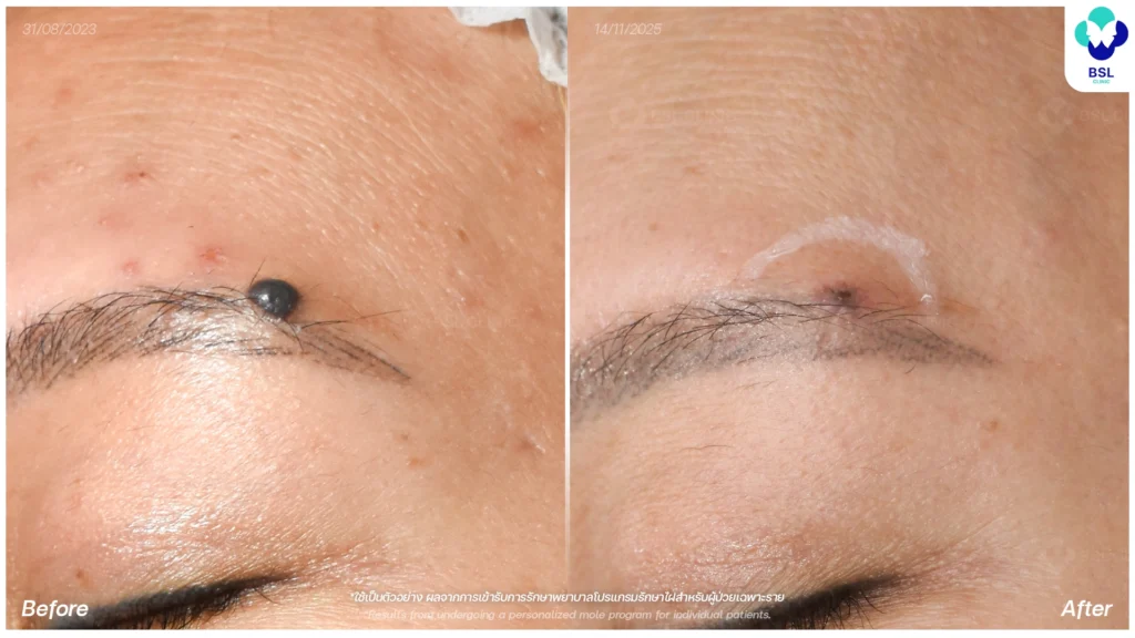 กำจัดไฝนูนหางคิ้ว