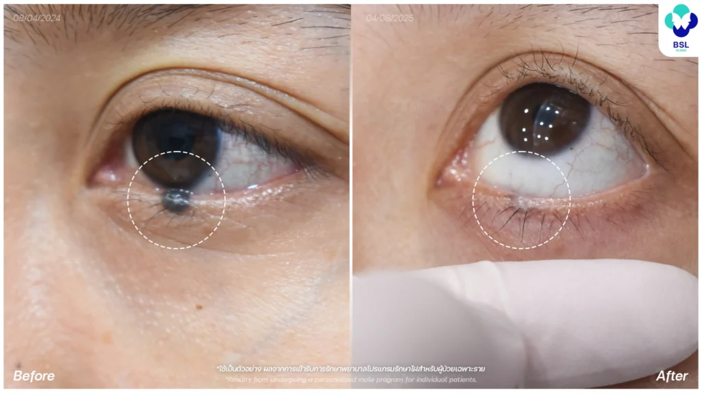 เลเซอร์ไฝนูนใกล้ตา