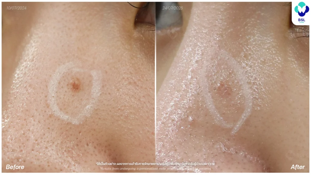 รักษาไฝแบนบนใบหน้า