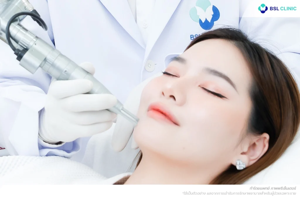 เลเซอร์ลดเม็ดสีฝ้า Lutronic Laser Program