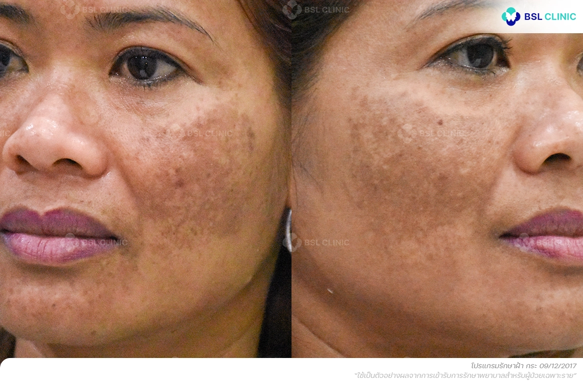 ก่อนรักษาฝ้า