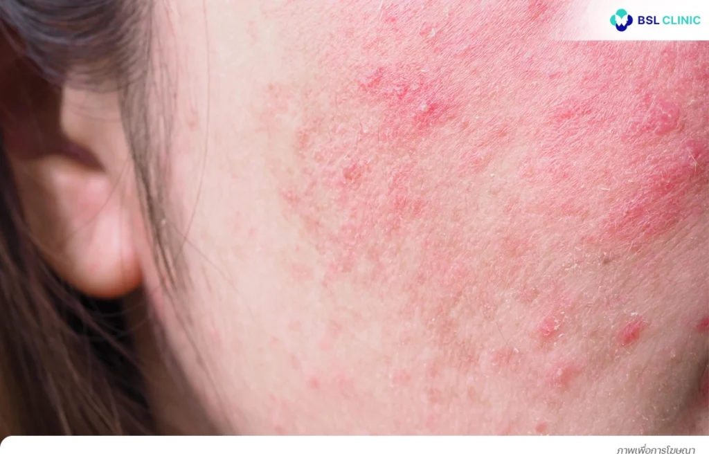 ผิวอักเสบ ระคายเคือง ปัจจัยกระตุ้นการเกิดฝ้าที่โหนกแก้ม