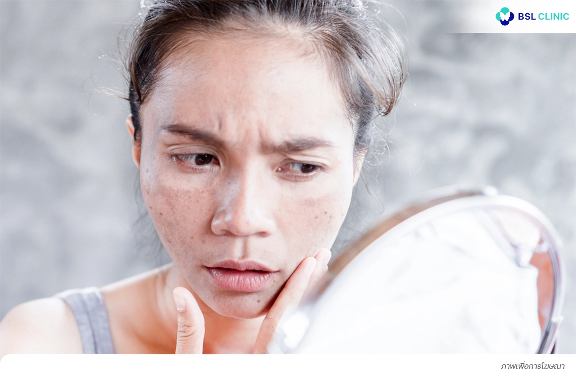 ผู้หญิงอายุ25–50 ปี และมีคนในครอบครัวเป็นฝ้า