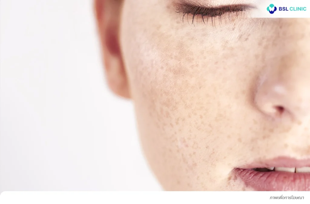 ฮอร์โมนเพศหญิง ปัจจัยกระตุ้นการเกิดฝ้าที่โหนกแก้ม