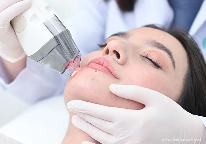 Fraxel-เลเซอร์รักษาสิว-สิวอุดตัน