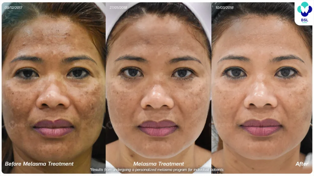 Timeline_รักษาฝ้า กระ ฝ้าแดด ฝ้าเข้ม ผลการรักษา