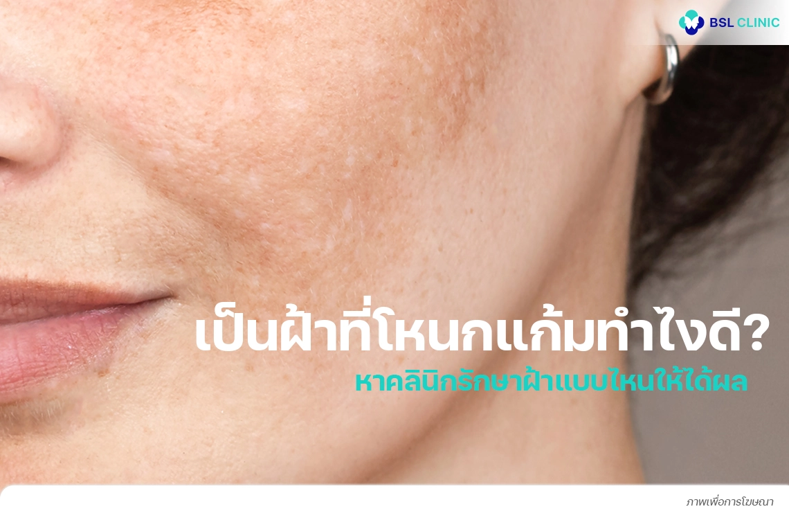 เป็นฝ้าที่โหนกแก้ม ทำไงดี? หาคลินิกรักษาฝ้าโหนกแก้มแบบไหนให้ได้ผล