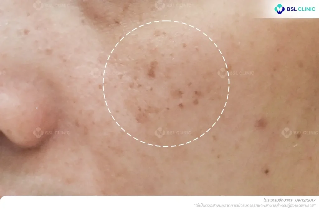 ก่อนรักษากระ