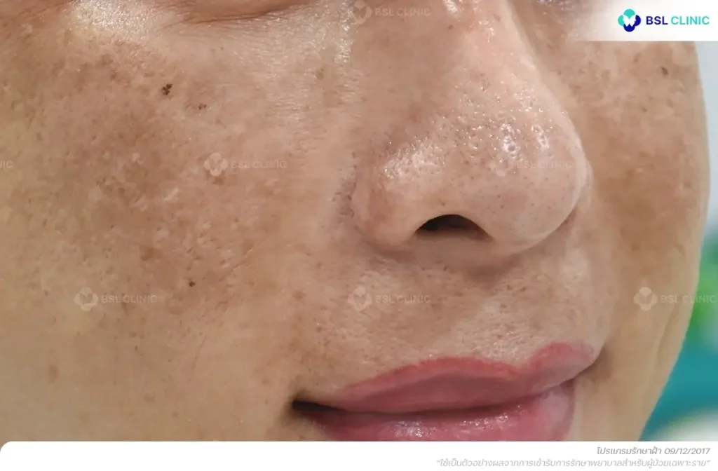 ก่อนรักษาฝ้า