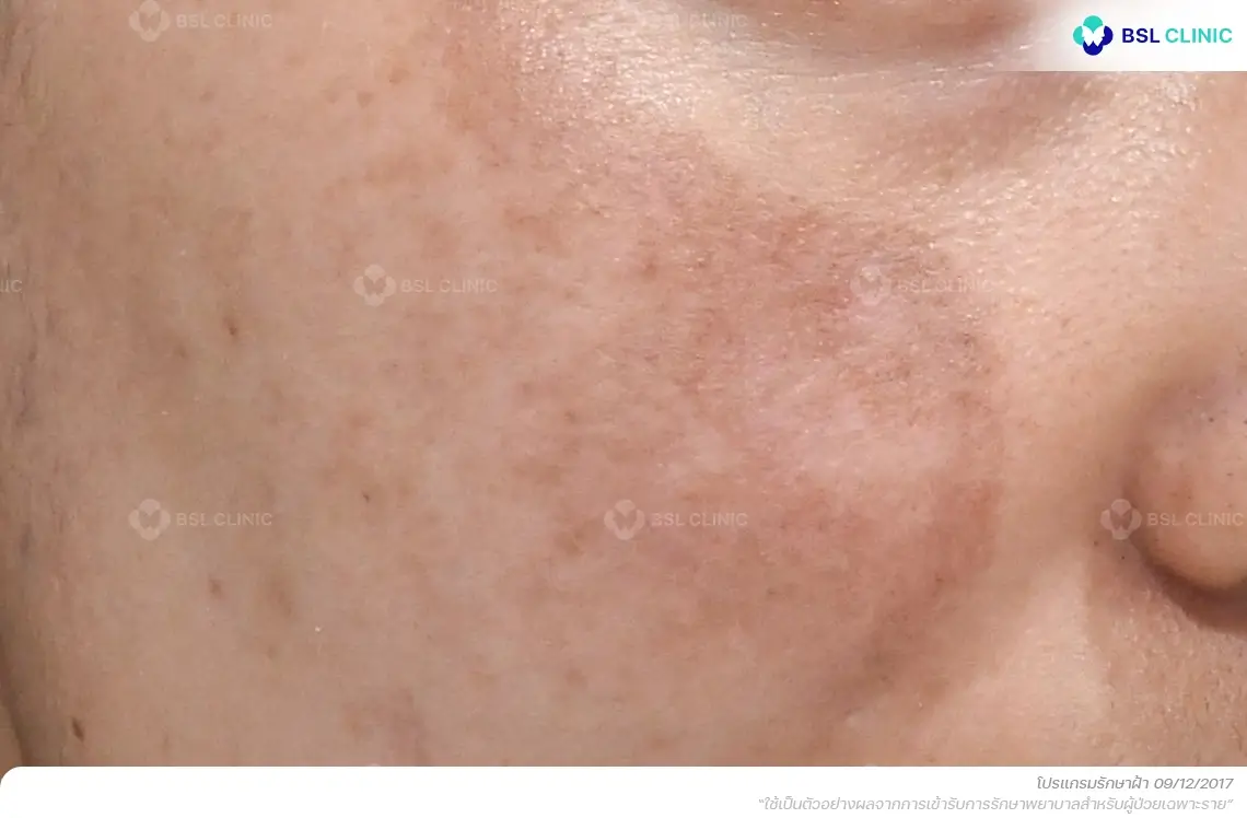 ก่อนรักษาฝ้า