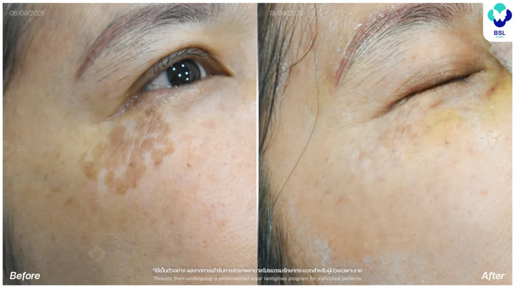 กระแดดรายครั้ง รักษากระ กระตื้น กระลึก