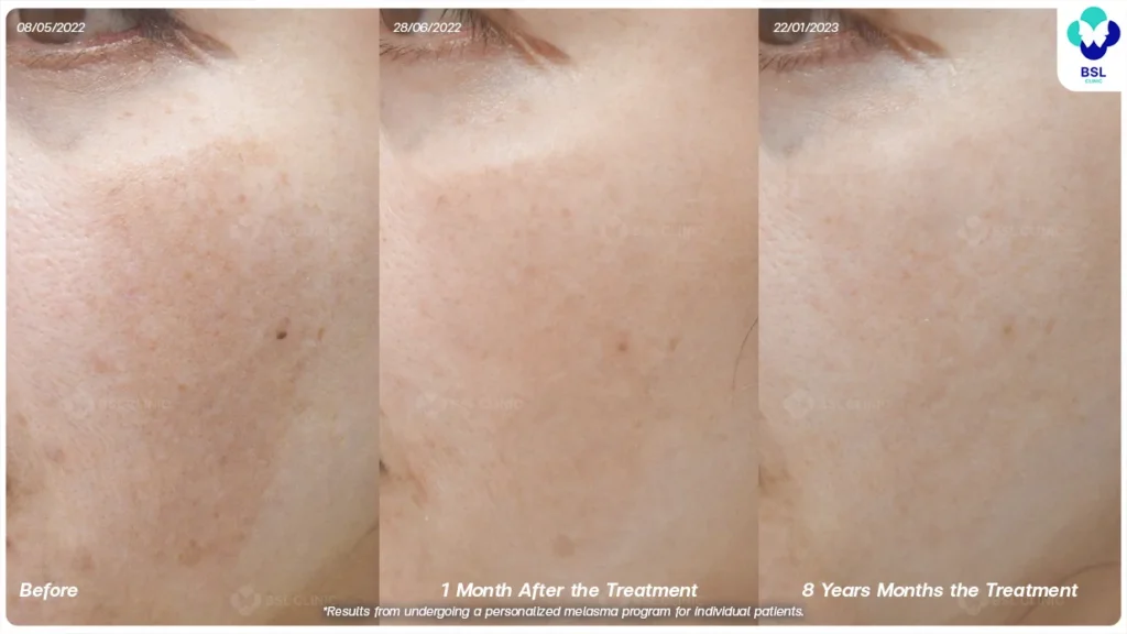 ก่อน-หลังรักษาฝ้า-คุณมาลิน ฝ้าแดด ฝ้าเข้ม ฝ้าฮอร์โมน