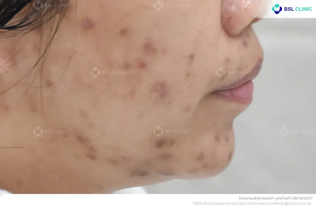 ก่อนรักษารอยดำ จุดด่างดำ