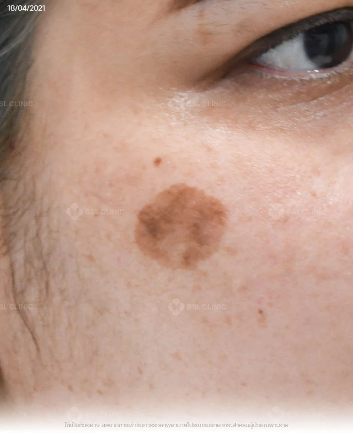 ผลการรักษากระ-กระตื้น-กระแดด-Before