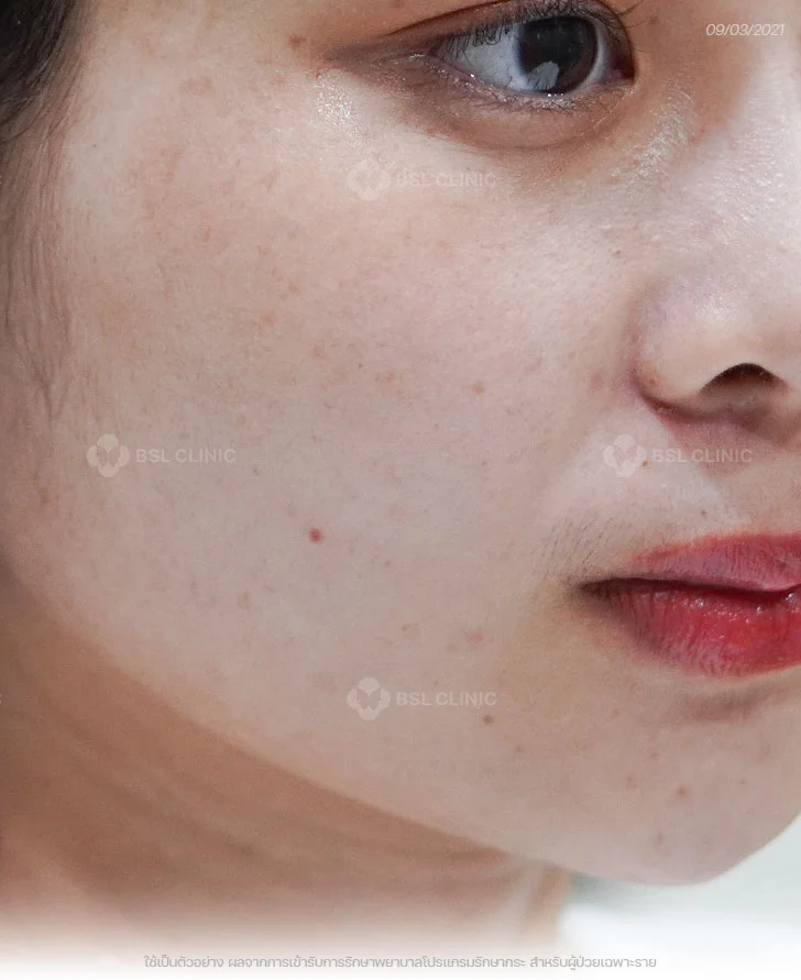 ผลการรักษากระ-กระตื้น-เลเซอร์กระ-After