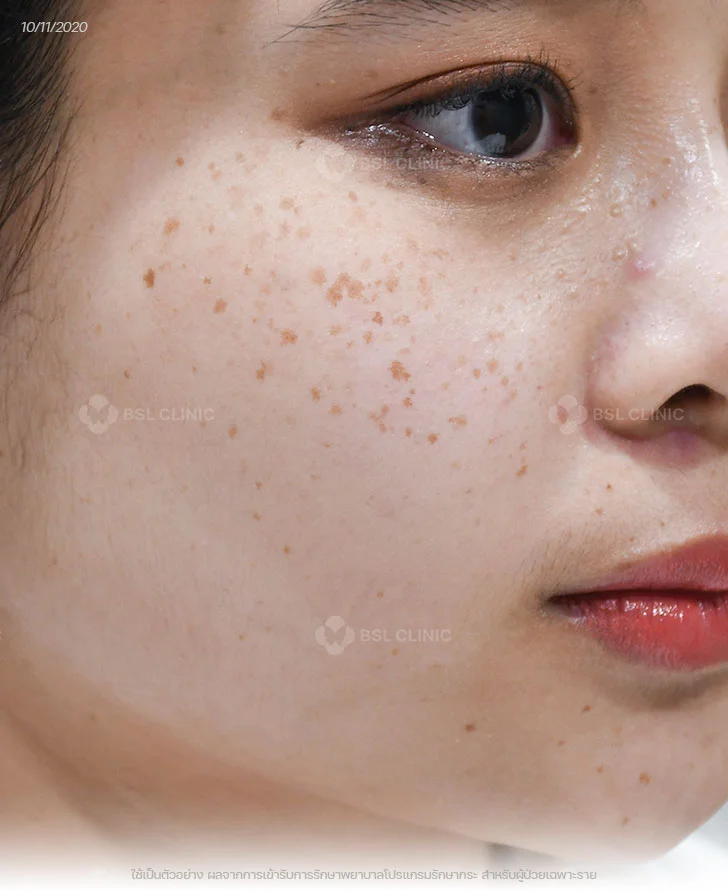 ผลการรักษากระ-กระตื้น-เลเซอร์กระ-Before